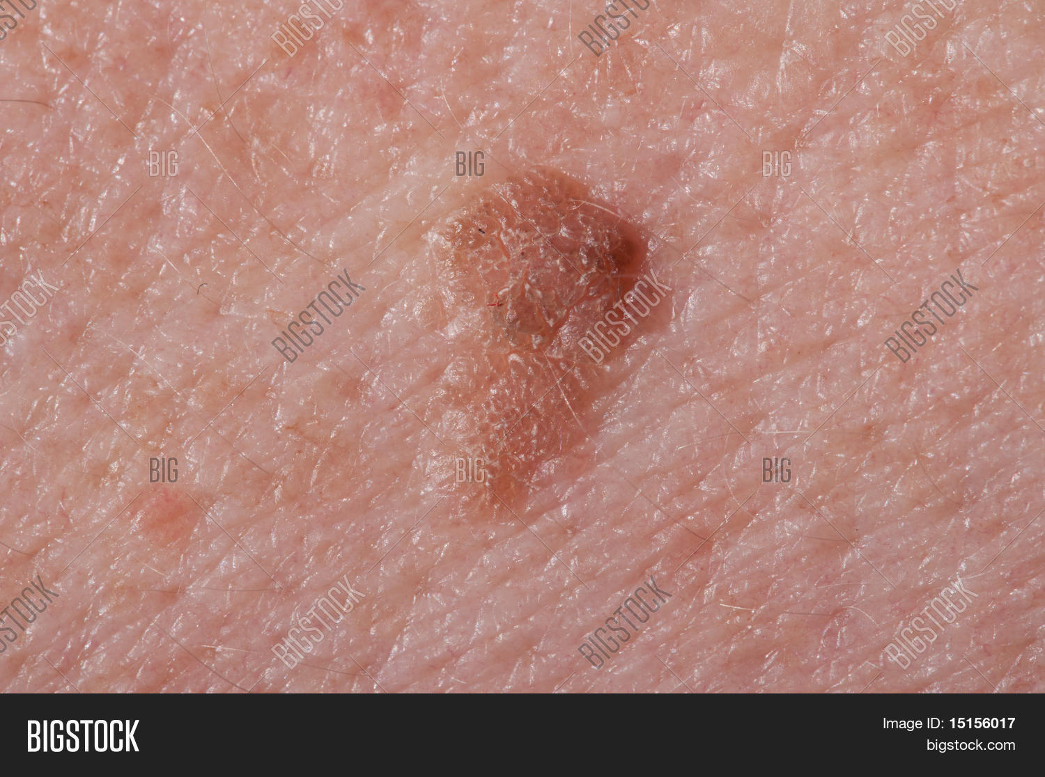Liver Spots Stock Photo & Stock Images Bigstock
