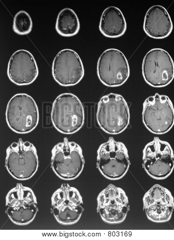 Ct+scan+brain+tumor+images