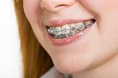 foto of bites  - Beautiful young woman with brackets on teeth close up - JPG 