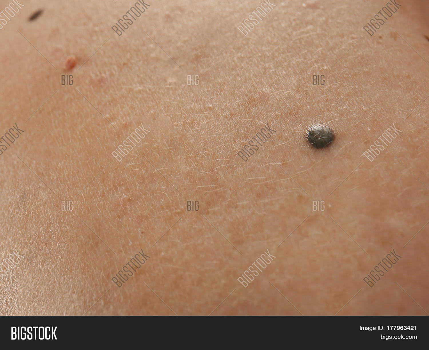 human skin stock photo 169 chaoss 1695911 human skin with birthmarks closeup stock photo stock images bigstock human skin stock photo 169 chaoss 1695911 human skin with birthmarks closeup stock photo stock images bigstock