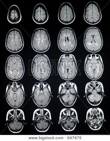 multiple sclerosis mri scan. Help me deciper my MRI brain