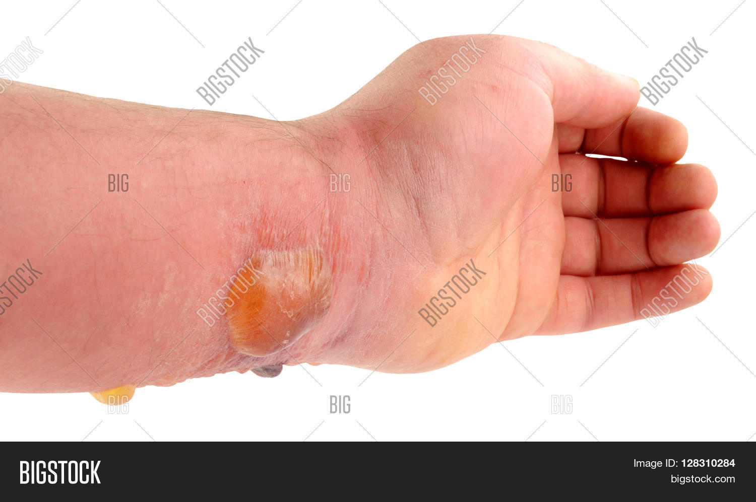 Arm Blisters Caused By Severe Image & Photo Bigstock