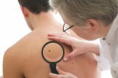 pic of males  - Dermatologist examines a mole of male patient - JPG 