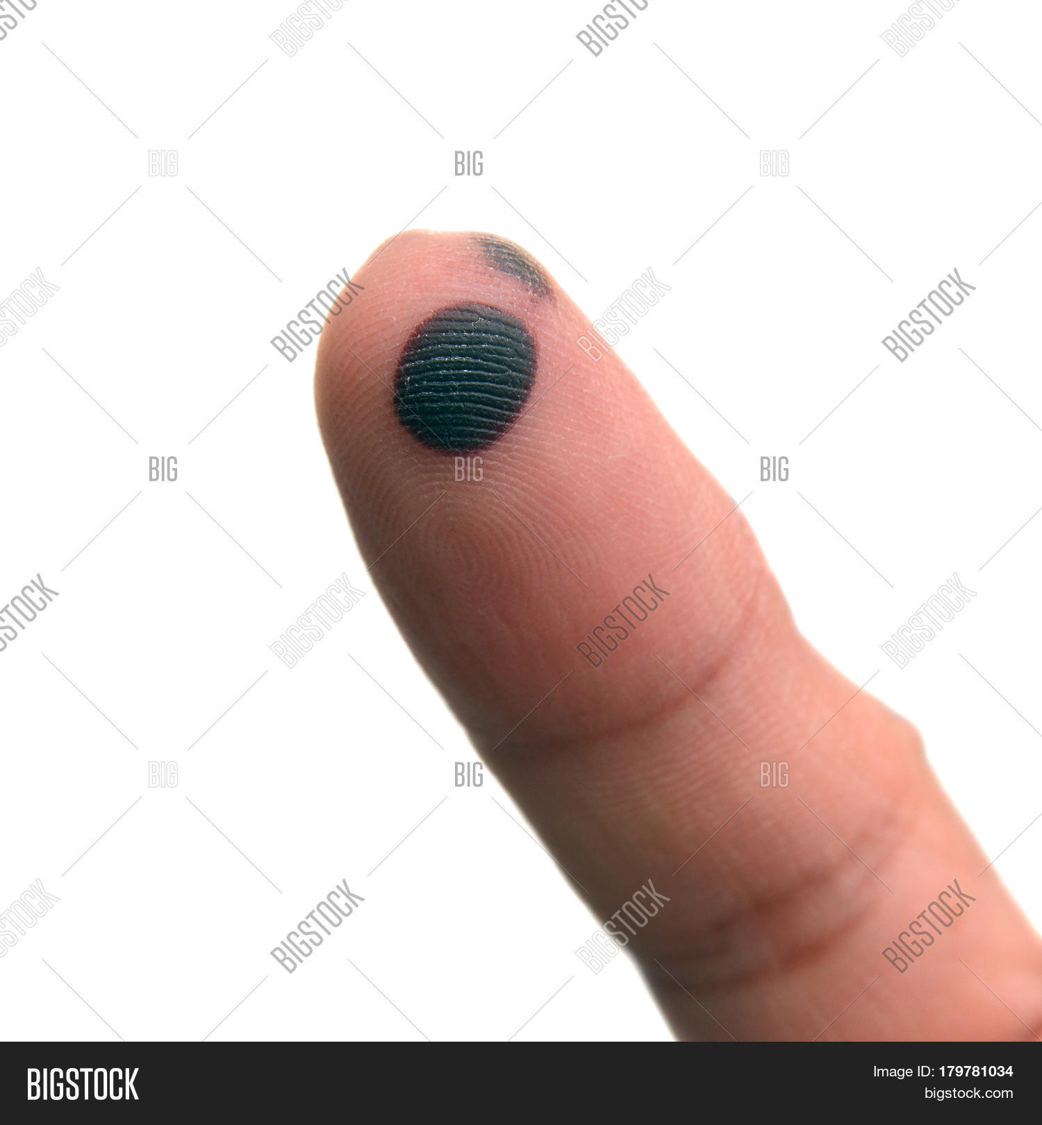 Small Bruise On Finger, Haematoma Image & Photo Bigstock