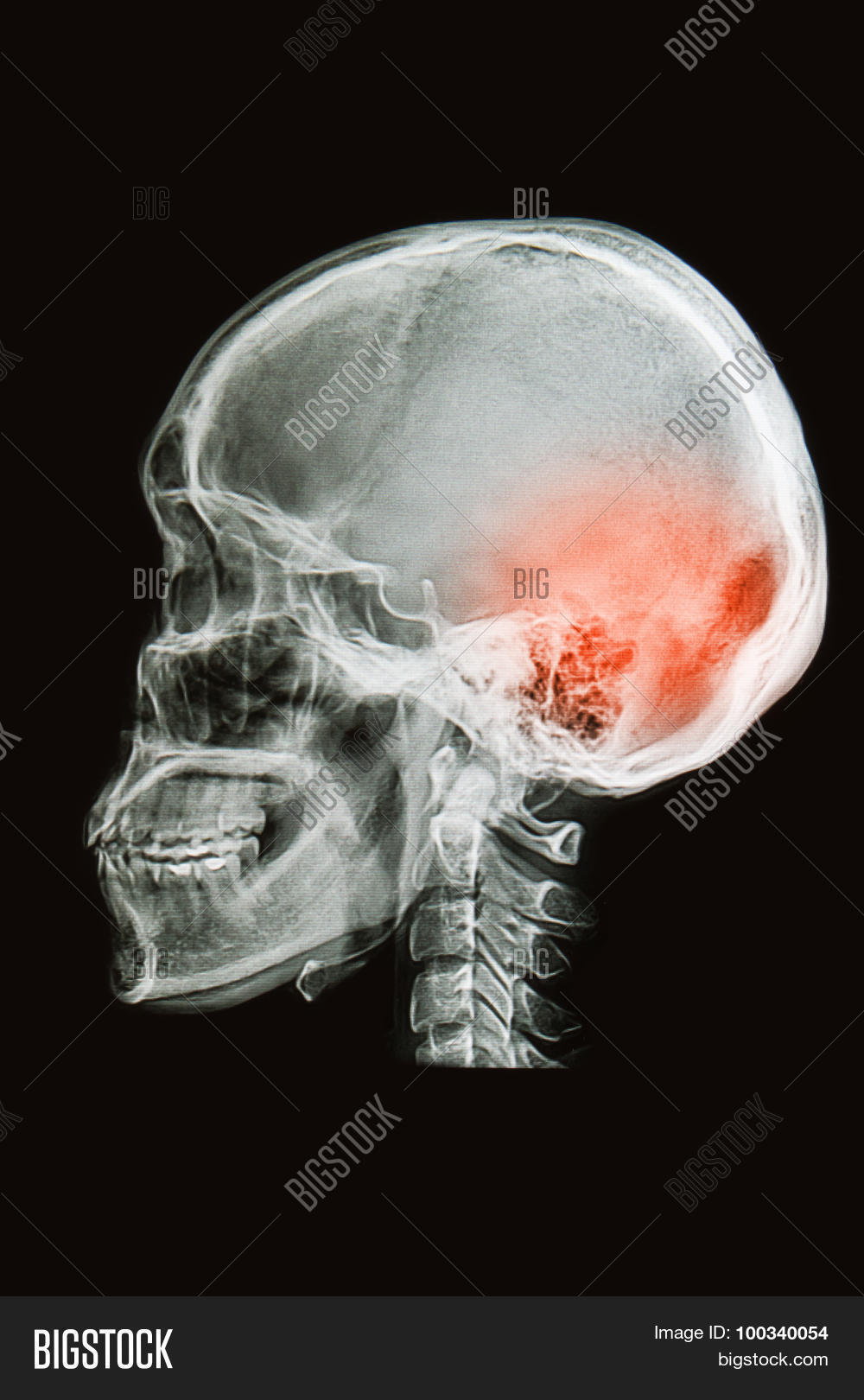 X Ray Head