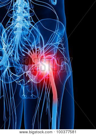 medically accurate illustration of a painful sciatic nerve