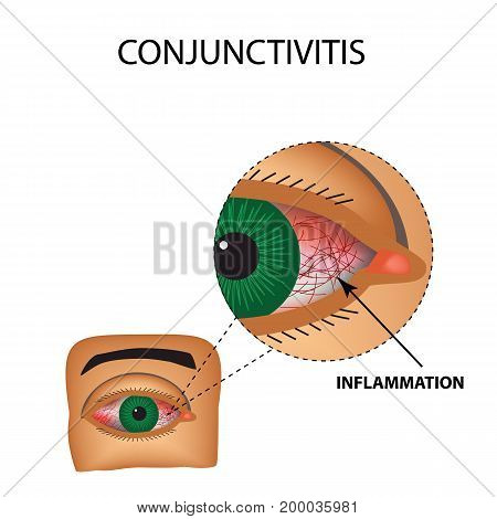 Conjunctivitis. Redness and inflammation of the eye. Vessels in the eye. Infographics. Vector illustration on isolated background.