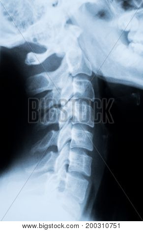 X-Ray photo of a human neck and skull.