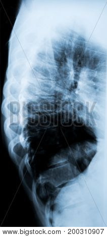 X-Ray photo of a human backbone .