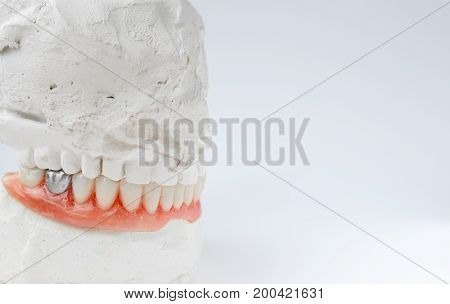 Artificial tooth, dental prosthesis with false silver tooth, metalic crown on tooth. Denture