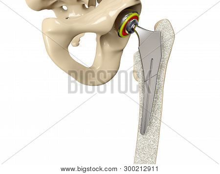 3d Illustration Of Hip Replacement Implant Installed In The Pelvis Bone