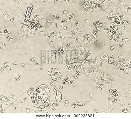 Epithelium Cells And Leukocytes In Human Urine Sediment.