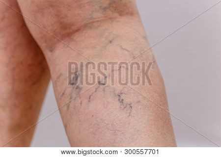 Trombose Images Illustrations Vectors Free Bigstock