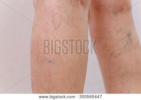 Elderly woman in white panties shows cellulite and varicose veins on a light isolated background. Co