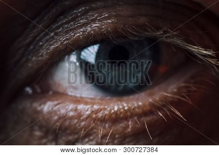 The Eye Is Severely Inflamed. Macro Reddening. Have Toning. Focus On The Eyelash.