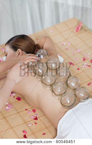 .a Chinese Medicine Cupping Of The Young Lady.
