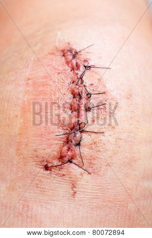 Scar From Operation With A Black Fiber