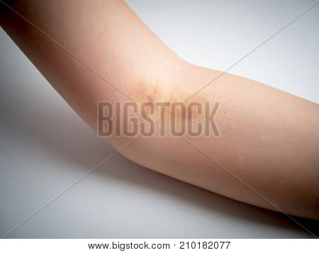 bruises on woman arm skin isolated on white background