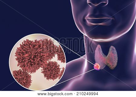 Thyroid cancer. 3D illustration showing thyroid gland with tumor inside human body and closeup view of thyroid cancer cells