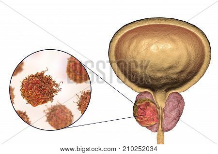 Prostate cancer, 3D illustration showing tumor inside prostate gland and closeup view of cancer cells