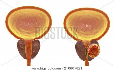 Prostate cancer, 3D illustration showing normal prostate gland and presence of tumor inside prostate gland which compresses urethra. Unlabeled image