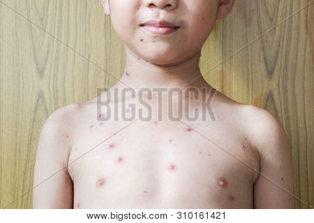 Chicken Pox Rash On Young Boy Body.chickenpox Is An Infection Caused By The Varicella Zoster Virus. 