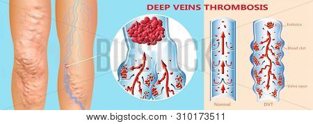 Deep Vein Thrombosis Or Blood Clots. Embolus. Structure Of Normal And Varicose Female Veins. Illustr