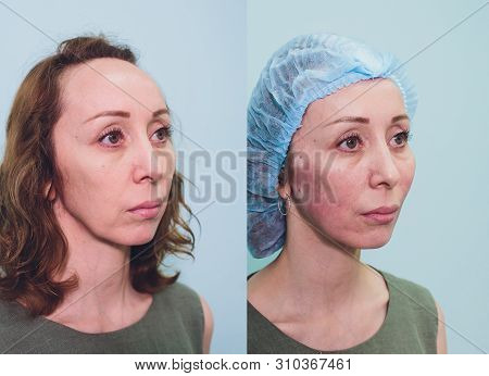 Aged Woman Doing Mesothreads And Thread Lifting, Cosmetology. Cosmetic Procedure To Eliminate Signs 