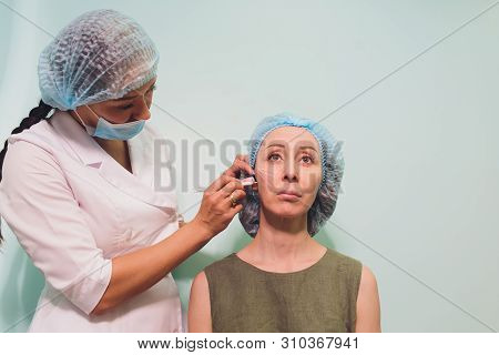 Aged Woman Doing Mesothreads And Thread Lifting, Cosmetology. Cosmetic Procedure To Eliminate Signs 