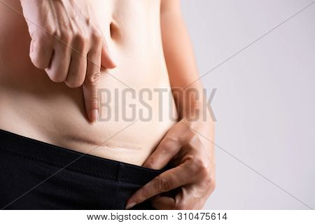 Closeup Of Woman Showing On Her Belly Dark Scar From A Cesarean Section. Healthcare Concept.