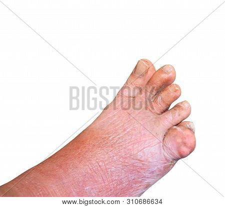 Gout Foot Little Finger In Aged People Close Up On White Background