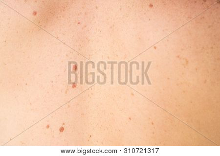 Close Up Detail Of The Bare Skin On A Man Back With Scattered Moles And Freckles. Checking Benign Mo