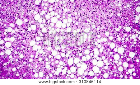 Histopathology Of Liver Steatosis, Or Fatty Liver. Light Micrograph, Photo Under Microscope
