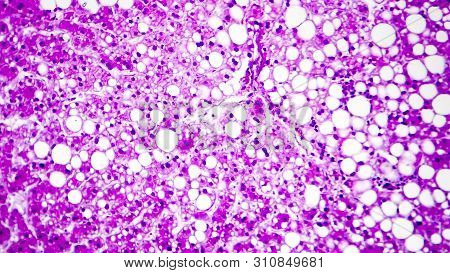 Histopathology Of Liver Steatosis, Or Fatty Liver. Light Micrograph, Photo Under Microscope