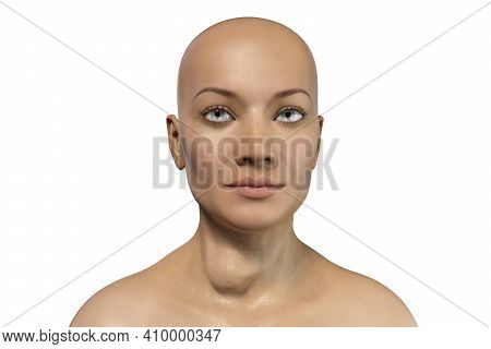 Thyroid Tumor, 3d Illustration Showing Nodule Inside Thyroid Gland