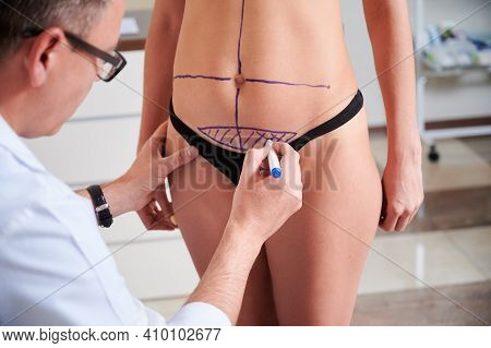 Close Up Of Male Doctor Drawing Marks On Woman Bare Skin Before Plastic Surgery. Female Patient In B