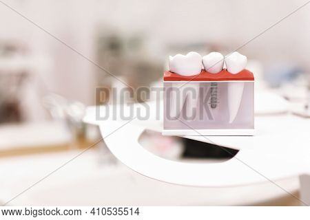 Dentist Dental Teeth Teaching Model Showing Titanium Metal Tooth Implant Screw. Generic Dental Impla