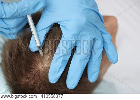 Doctor Trichologist Makes An Injection Into The Scalp Of Man. Hair Loss In Men Causes And Treatment 