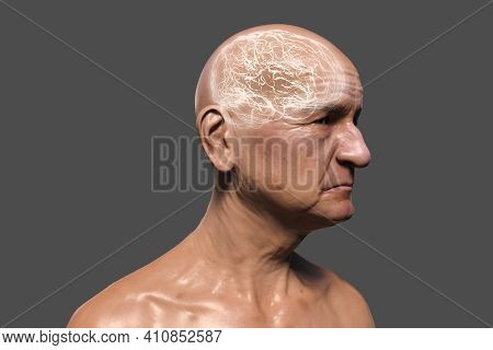 Dementia, Conceptual 3d Illustration Showing An Elderly Person With Progressive Impairments Of Brain