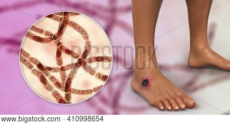 Cutaneous Anthrax, The Most Common Form Of Anthrax. 3d Illustration Showing The Characteristic Black