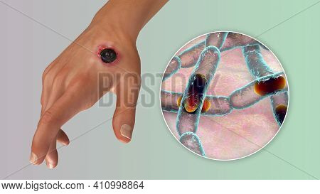 Cutaneous Anthrax, The Most Common Form Of Anthrax. 3d Illustration Showing The Characteristic Black