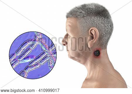 Cutaneous Anthrax, The Most Common Form Of Anthrax. 3d Illustration Showing The Characteristic Black