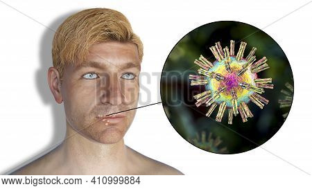 Herpes Labialis, Also Known As Cold Sores, 3d Illustration Showing Lesions On The Man's Lips Caused 