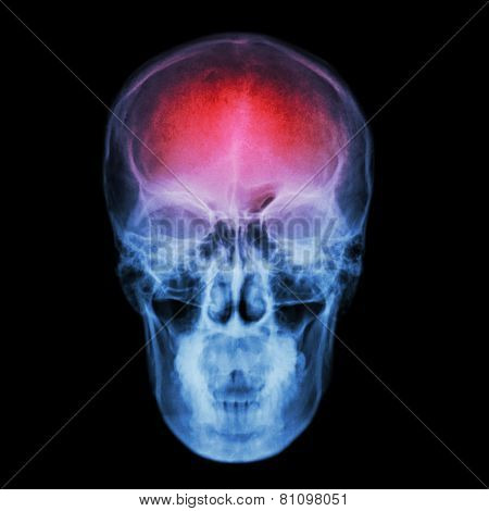 X-ray Skull And Stroke ( Cerebrovascular Accident (cva) )
