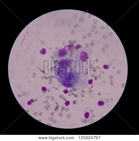 malignant cells with multiple nuclei and prominent nucleoli.Mesothelial cells