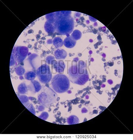 malignant cells with multiple nuclei and prominent nucleoli.Mesothelial cells