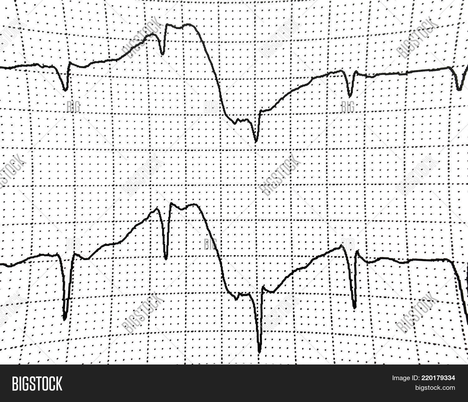 electrocardiogram-test-image-photo-free-trial-bigstock