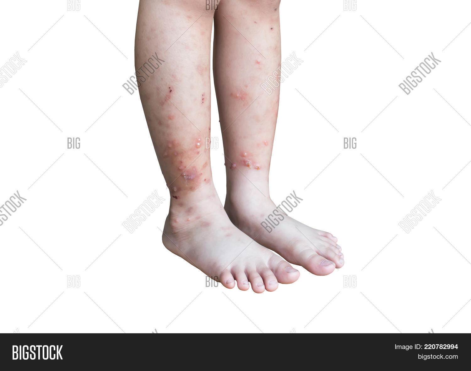 Leg Child Blister Burn Image & Photo (Free Trial) Bigstock