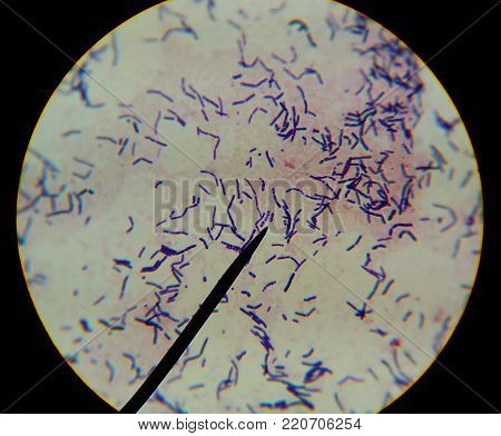 Acid Fast Bacilli Positive Red Cells.