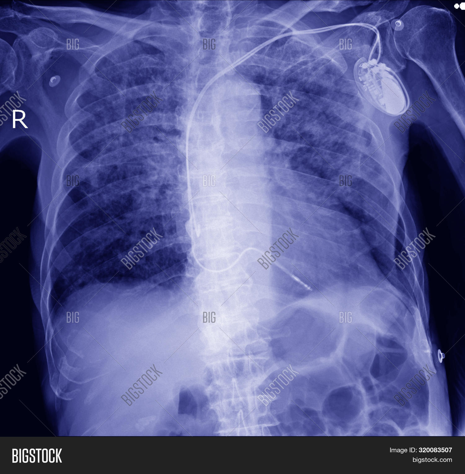кардиостимулятор рентген можно ли. кардиостимулятор на рентгене. кардиостимулятор рентген можно ли. кардиовертер-дефибриллятор на рентгене. рентген однокамерный кардиостимулятор.